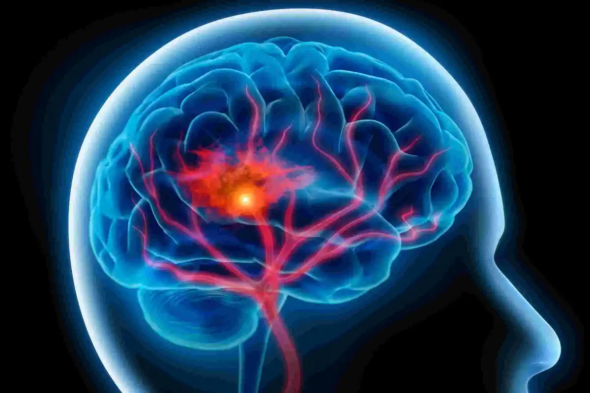 Stroke: Definisi Lengkap, Penyebab, Gejala, dan Cara Pencegahan